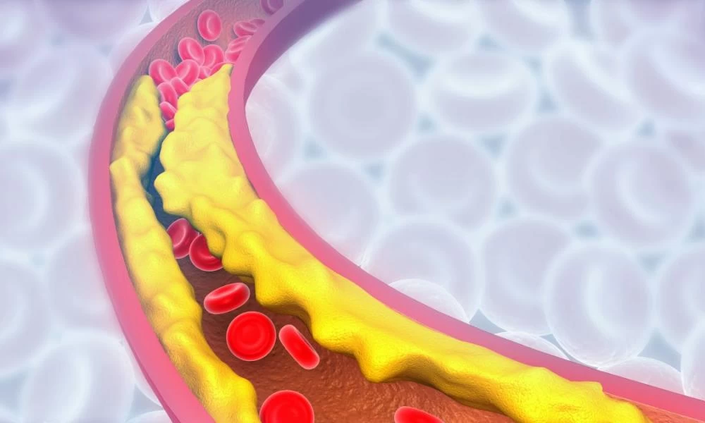 Χοληστερόλη: Τι να τρώτε και τι να αποφεύγετε για να τη ρίξετε
